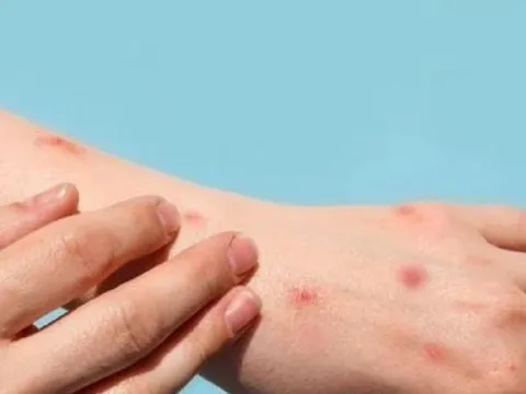 Bến Tre ghi nhận ca đậu mùa khỉ đầu tiên, bệnh nhân tiếp xúc với nhiều người