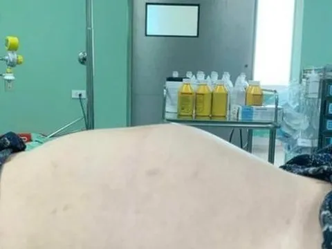 Thiếu nữ 18 tuổi bụng to như mang thai 7 tháng, không ngờ u buồng trứng ‘khủng’