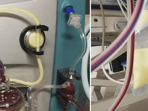 Kỳ lạ người phụ nữ có máu đục như sữa