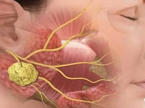 Dấu hiệu nhận biết sớm ung thư vòm họng