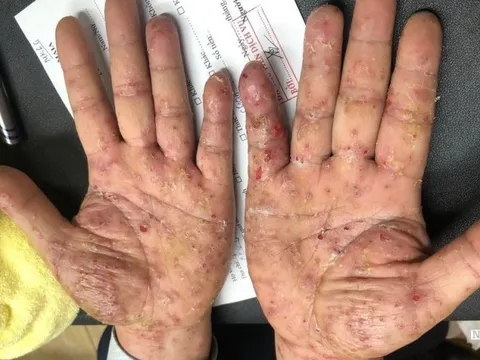 Xuất hiện sẩn ngứa cả gia đình bất ngờ khi được chẩn đoán bệnh