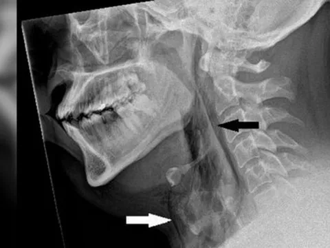 Người đàn ông bị rách khí quản vì nhịn hắt hơi