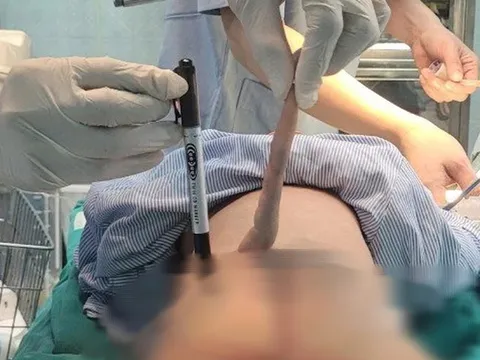 Thoát vị màng não tủy: Bé 4 tháng tuổi có đuôi bất thường vùng cùng cụt