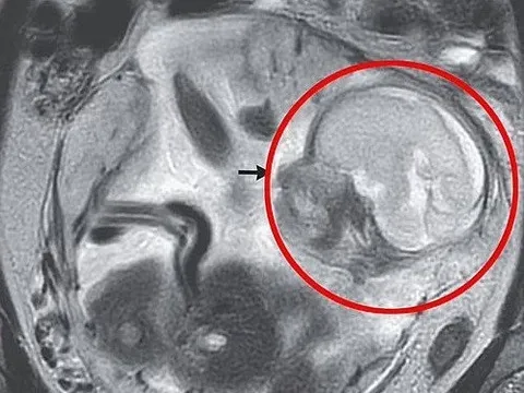 Đau bụng đi khám, bác sĩ sốc nặng khi siêu âm cho người phụ nữ