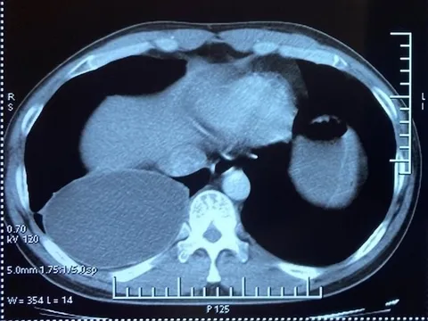 Hà Nội: Ăn nhiều thực phẩm tái, sống người đàn ông nhiễm ấu trùng