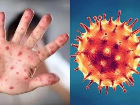 Kiên Giang ghi nhận 3 trường hợp mắc bệnh đậu mùa khỉ