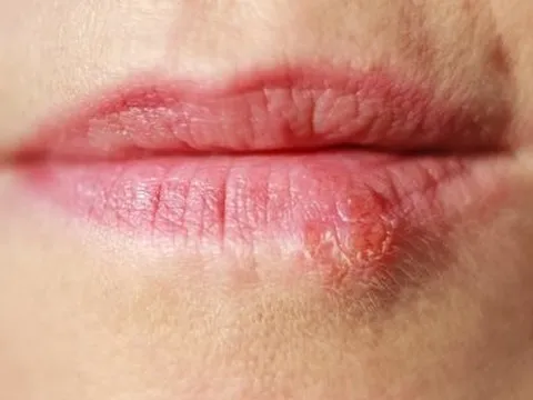 Thiếu nữ nhận kết đắng khi mua mỹ phẩm "xịn" giá hời trên mạng