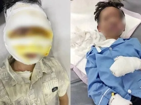 Thêm một học sinh 8 tuổi bị bỏng nặng do laptop phát nổ, chuyên gia đưa ra cảnh báo