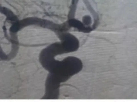 Người đàn ông bị đột quỵ vì bị tăng huyết áp nhưng uống thuốc không đều