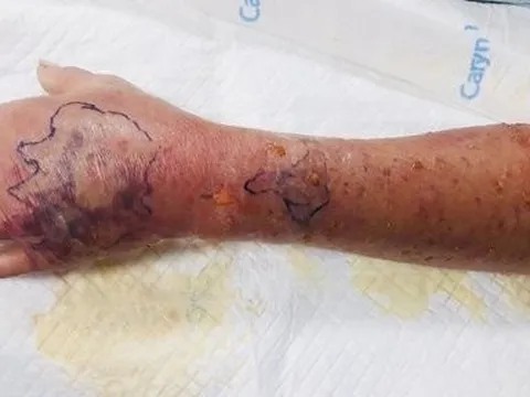 Bị cháu 3 tuổi cắn vào tay trong lúc chơi đùa, người đàn ông nhập viện